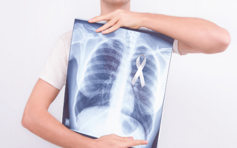 Variante genética encontrada  pelos pesquisadores pode ajudar a identificar determinadas populações com maior risco de câncer de pulmão